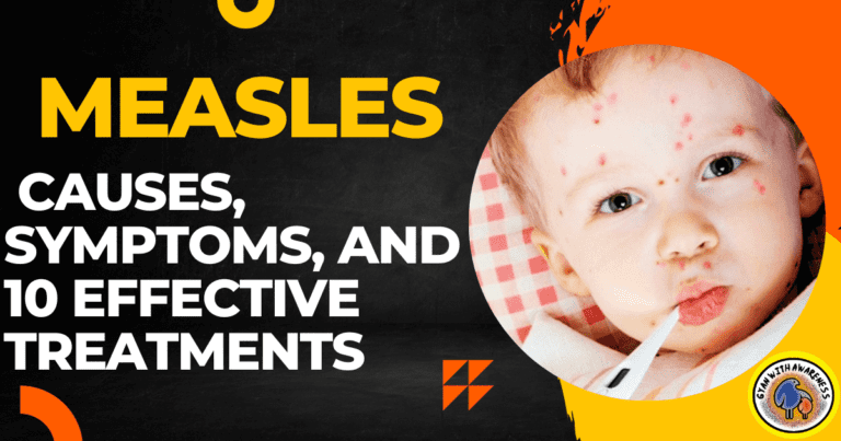 Measles: Causes, Symptoms, and 10 Effective Treatments