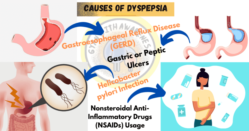 Dyspepsia icd 10 Code, Causes, Symptoms, and Best Treatment