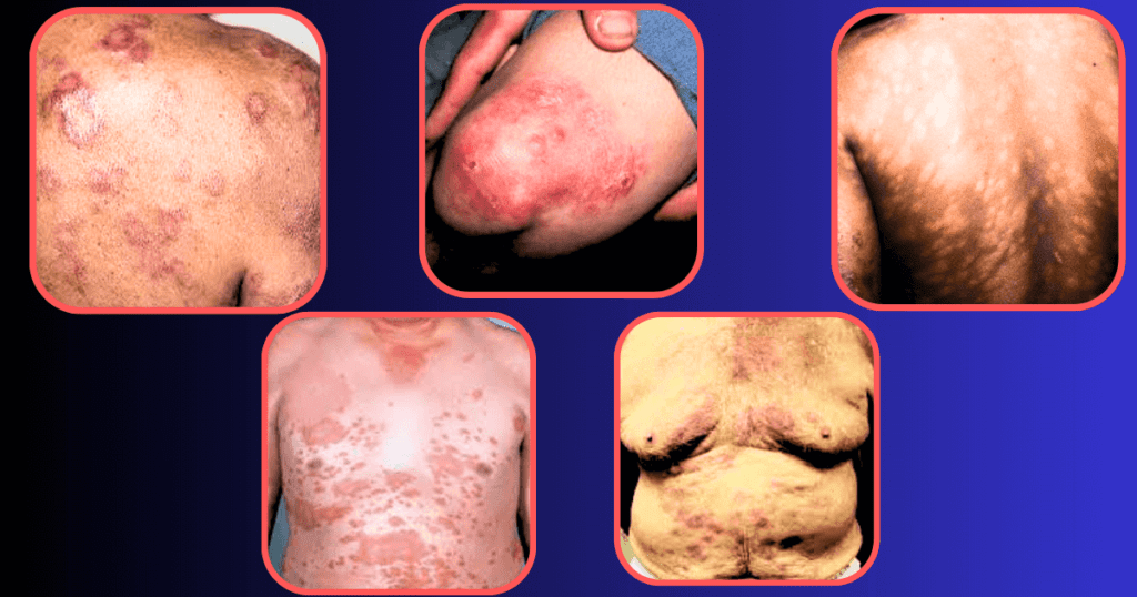 Leprosy: Causes, Symptoms, and 10 Effective Treatments
